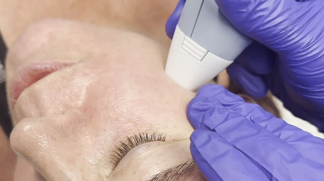 Microneedling for Longevity in Sarasota: Beyond Before-and-After Photos