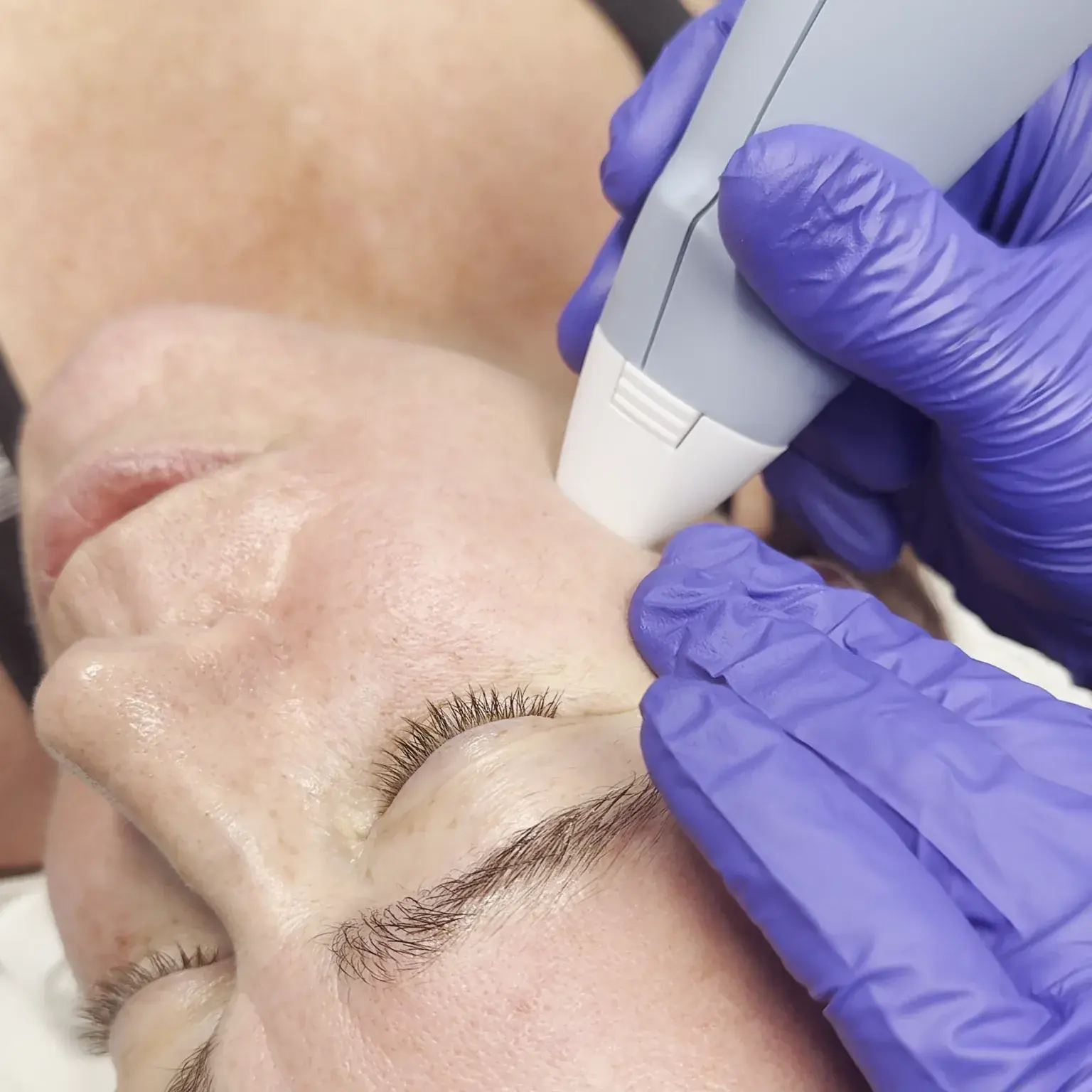Acne scars & skin texture