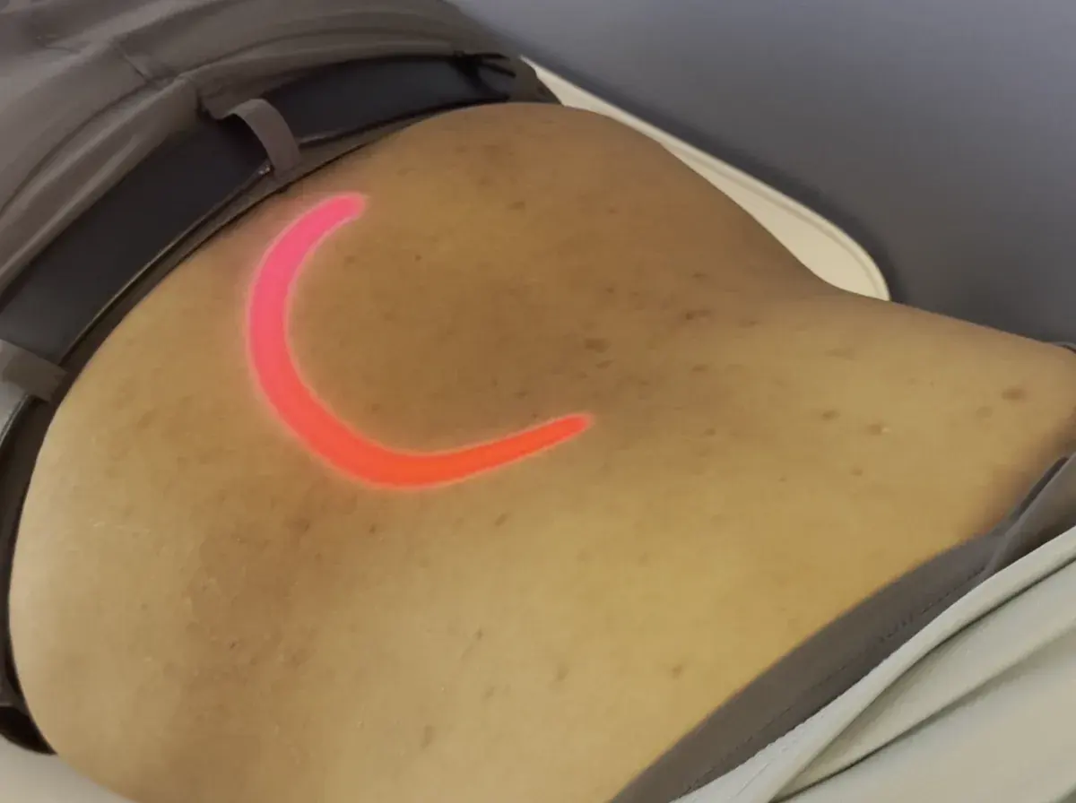 EmVital handpiece in use at Lesh Lifestyle