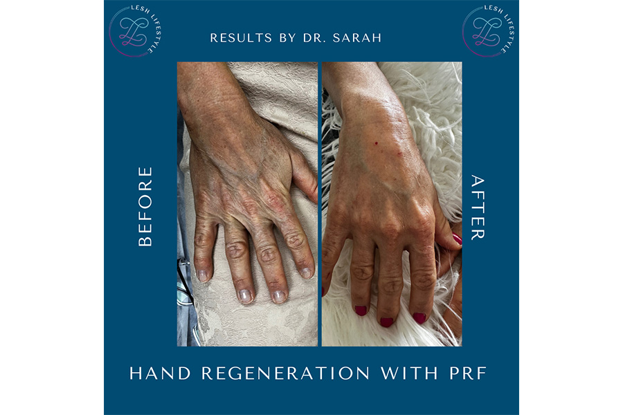 hand-regeneration-Sarasota-Lakewood-Ranch-Parrish